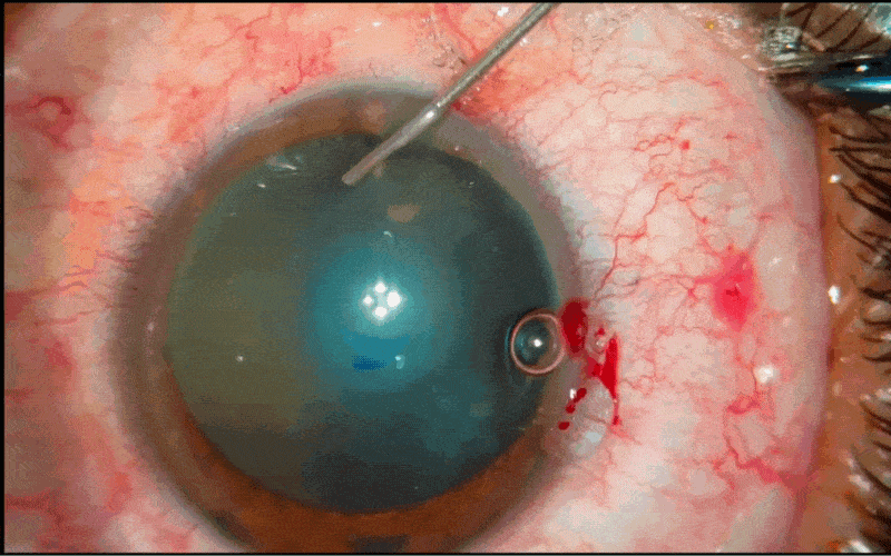 Gif of a Cataract surgery - capsulorhexis step